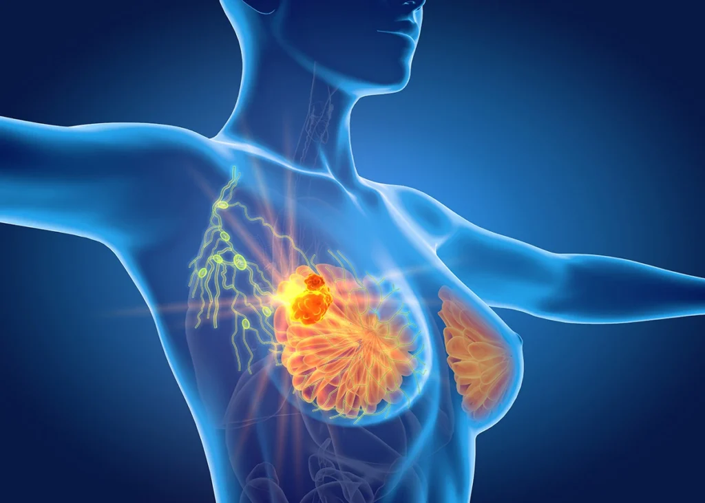 Indian Scientists Develop New Compound to Combat Aggressive Breast Cancer